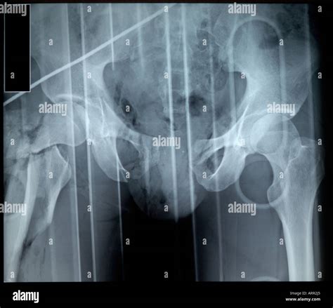 Intertrochanteric fracture hi-res stock photography and images - Alamy
