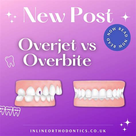 Overjet Vs Overbite Difference Between Overjet And Overbite Flash