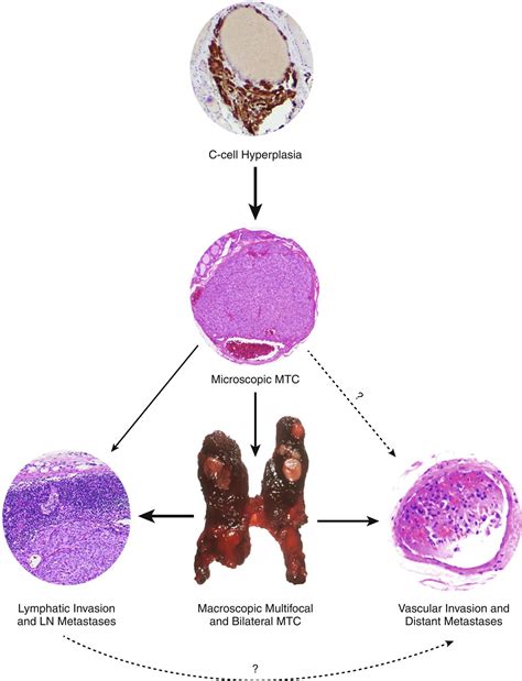 Pheochromocytoma/Paraganglioma, Medullary Thyroid Carcinoma, and Hereditary Endocrine Neoplasia ...