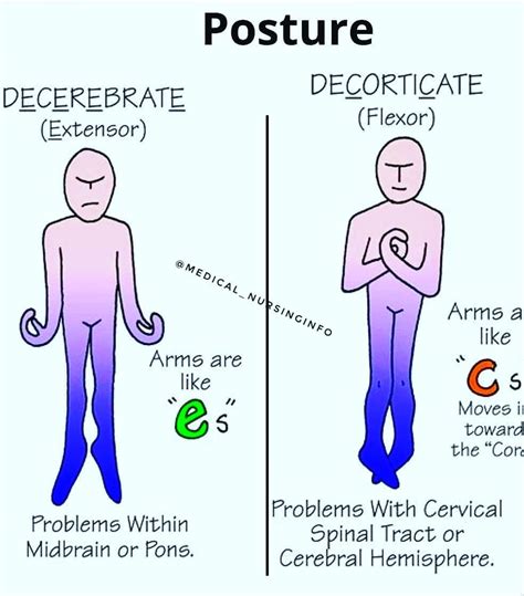 Image result for Decorticate Posture