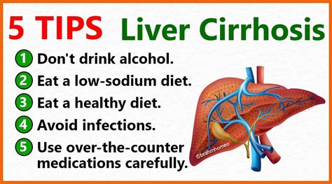 Cirrhosis Of Liver | Cirrhosis Of Liver Treatment | Cirrhosis Of Liver ...