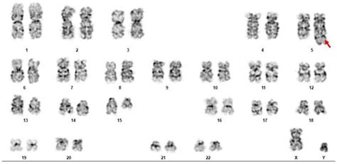 Novel NUTM1 Fusions in Relapsed Acute Myeloid Leukemia: Expanding the ...
