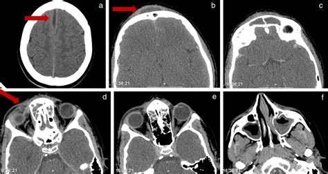 SciELO - Brasil - Pott's puffy tumor: rare complication of sinusitis Pott's puffy tumor: rare ...