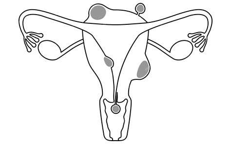Diagrammatic illustration of uterine fibroids anatomy of the uterus and ...