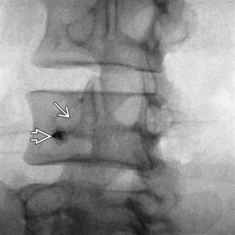 Image result for Selective Nerve Root Block