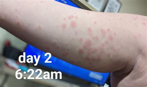 Mononucleosis Amoxicillin Rash