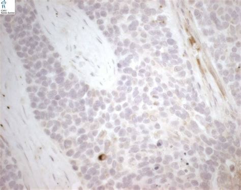 desmoplastic small round cell tumor - Humpath.com - Human pathology ...