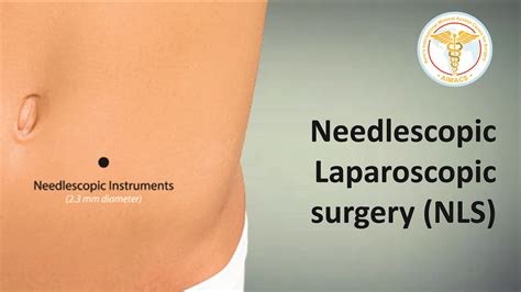 Recovery after Laparoscopic Nissen’s Fundoplication. What to expect? – Professor Amir Nisar