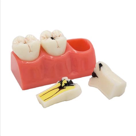 Buy SHUAI Tooth Model Dental Lesion Process Four Times Detachable ...