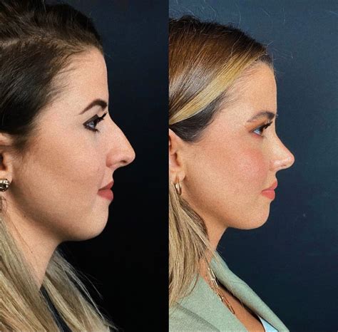 Barbie nose 💕 | Nose fillers, Nose job, Rhinoplasty nose jobs