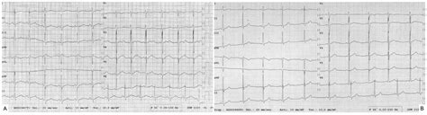 May Strenuous Endurance Sports Activity Damage the Cardiovascular ...