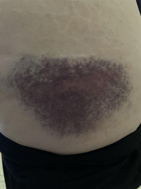 Advice for bruise from falling : r/medical_advice