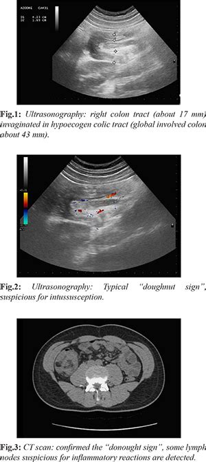 Large-B-Cell Lymphoma causing Intussusception in a Young Male: A ...