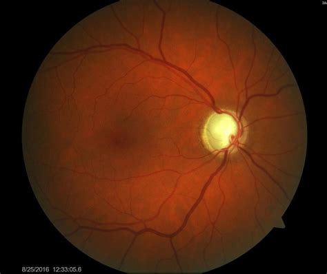 घातक है आँखों की बीमारी मैकुलर इडिमा, जाने लक्षण और उपचार