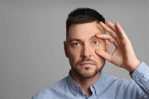 Jaundice: Symptoms, Causes, Types, Complications, Treatment