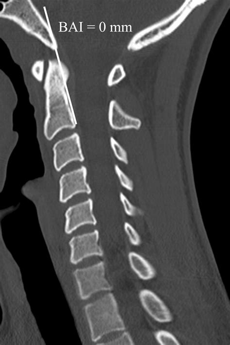 Reassessment of the Craniocervical Junction: Normal Values on CT ...