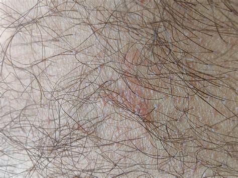 What Does Herpes Look Like On Cervix at Brianna Gellatly blog