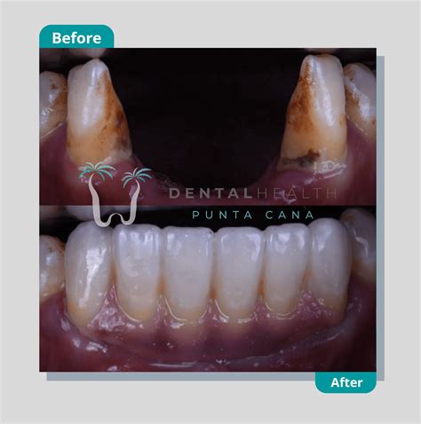 Types of Dental Crown Materials