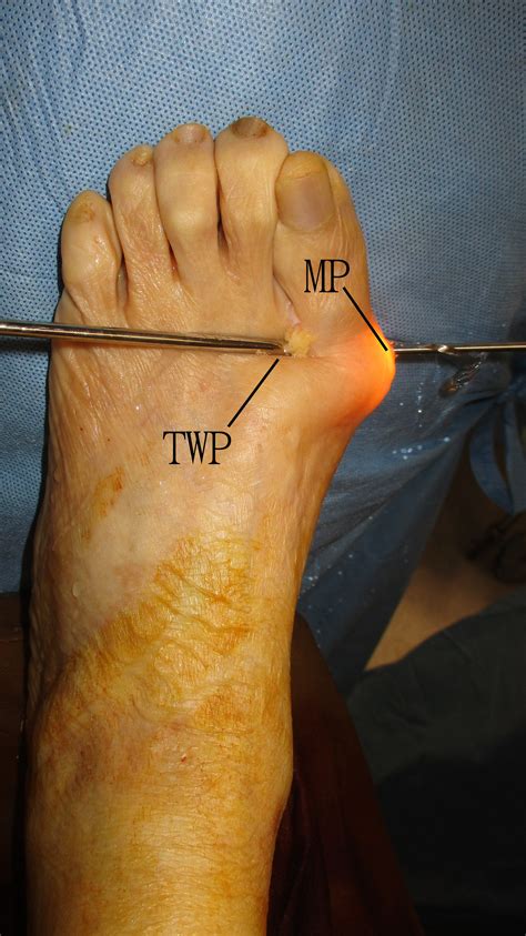 Arthroscopic Arthrodesis of the First Metatarsophalangeal Joint in ...