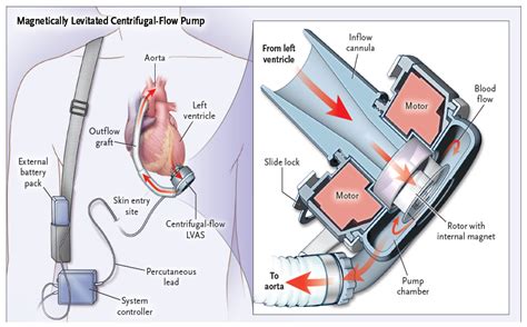 Ventricular Arrhythmias in Left Ventricular Assist Device Patients ...
