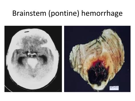 Cerebrovascular disease pathology stroke | PPT - hemorrhage in pons