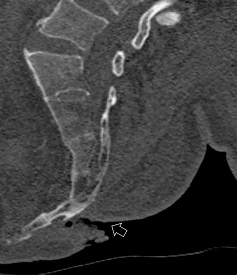 CT of Sacral Fractures: Classification Systems and Management | RadioGraphics