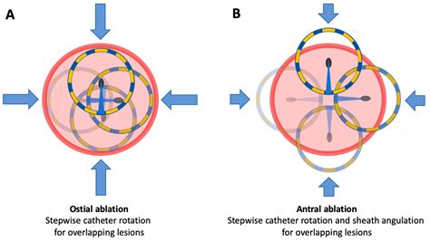 Comparative Analysis of Real-World Clinical Outcomes of a Novel Pulsed ...