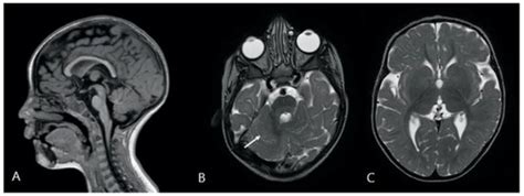 Expanding the Neurological Phenotype of Ring Chromosome 10 Syndrome: A ...