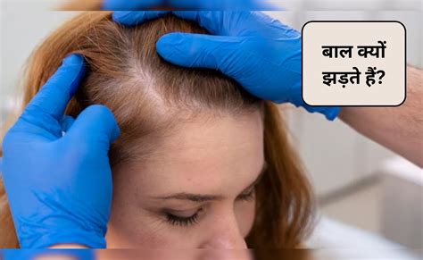 एलोपेसिया एरीटा बीमारी क्या होती है? क्या Alopecia Areata से ज्यादा बाल ...