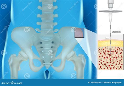 Bone Marrow Aspiration and Biopsy. Illustration of the Needle Extends into Bone Marrow Stock ...