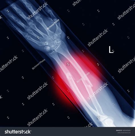 Стоковая фотография 1665445660: Xray Image Showing Fracture Radius Ulna ...
