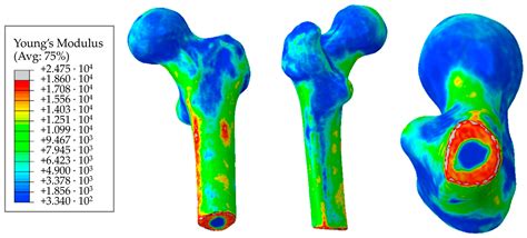Acetabular Implant Finite Element Simulation with Customised Estimate of Bone Properties