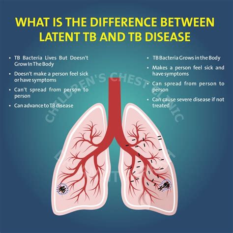 Latent Tuberculosis or Tuberculosis disease: What is the difference ...
