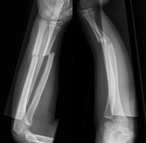 Ulna Bone Fracture