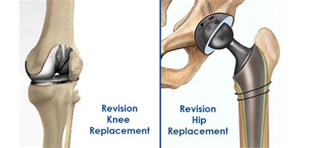 Bone, Joint, Hip, Knee Replacement Orthopedic Surgeon