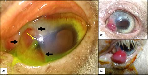 Pyogenic Granuloma Eye Treatment