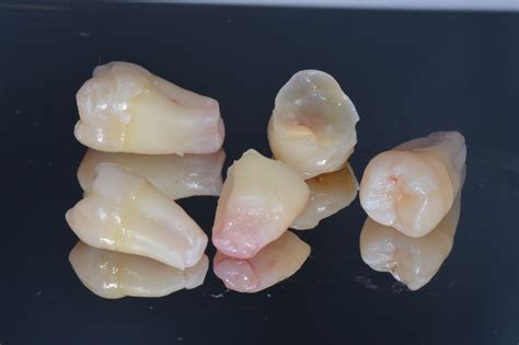 Image result for IV Line Wisdom Teeth