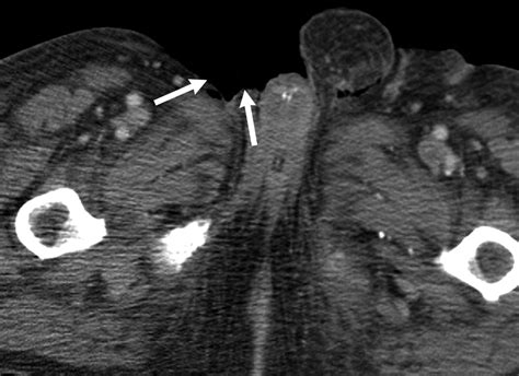 Fournier Gangrene: Role of Imaging | RadioGraphics