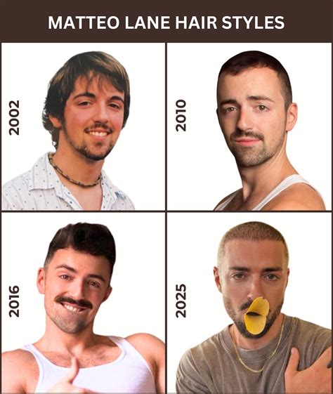 Matteo Lane Hair Transplant - Before and After