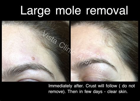 mole eye check removal Melbourne - Vista Clinic Melbourne