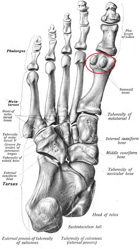Sesamoiditis causes, symptoms, diagnosis & treatment