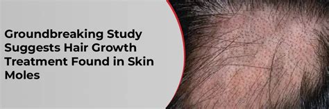 Groundbreaking Study Suggests Hair Growth Treatment Found in Skin Moles