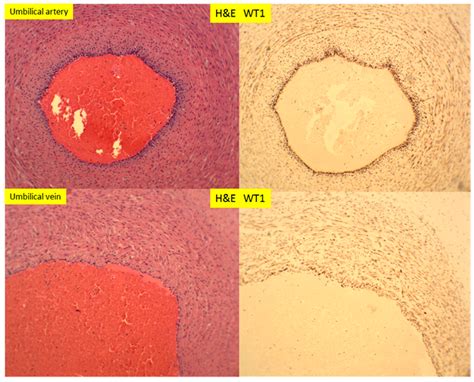 Expression of Wilm’s Tumor Gene (WT1) in Endometrium with Potential ...