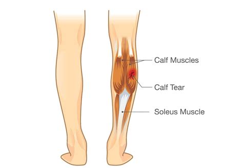 calf-muscle-tear ⋆ El Paso's Injury Doctors® 915-850-0900