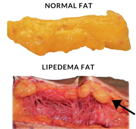 Lipedema – SBACVSP