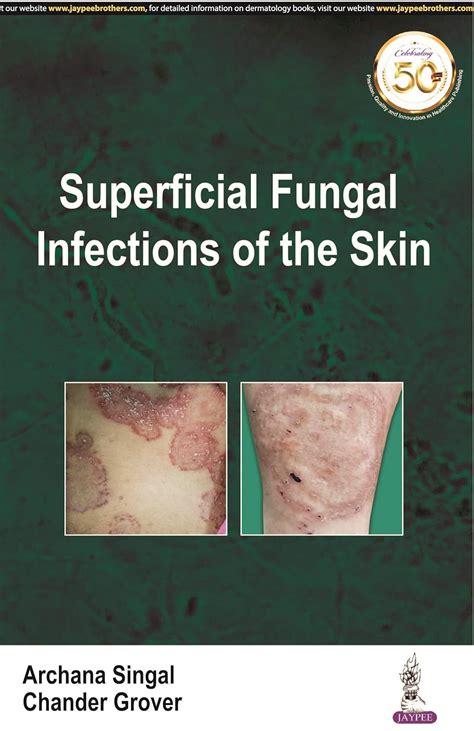 Buy Superficial Fungal Infections of the Skin (POD) Book Online at Low ...