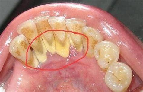 牙结石图片清晰,洗牙掉的牙结石图片 - 伤感说说吧