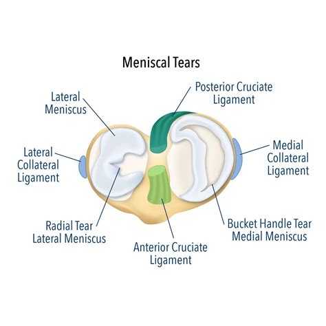Meniscus Tear Treatment | Meniscus Tear Surgery