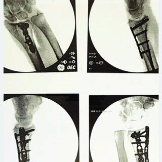 Image result for Open Reduction Distal Radius Fracture