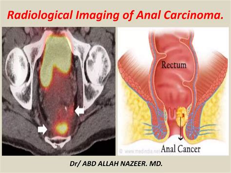 Presentation1, radiological imaging of anal carcinoma. | PPTX